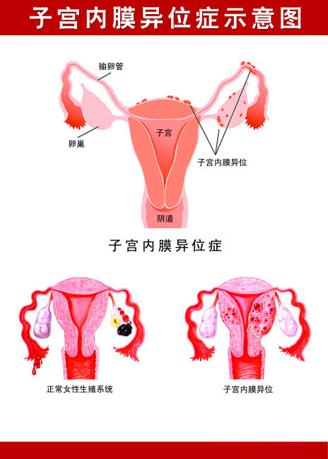 子宫内膜异位症