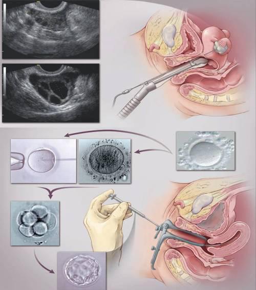 取卵子的过程图片图片