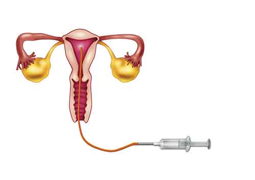 多囊卵巢综合征患者能做试管婴儿助孕