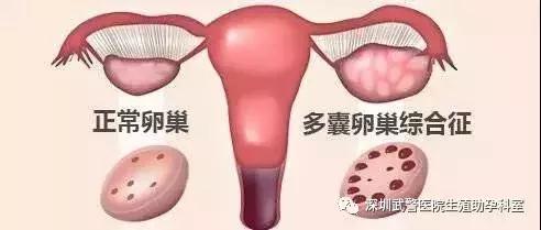 多囊卵巢专题交流会