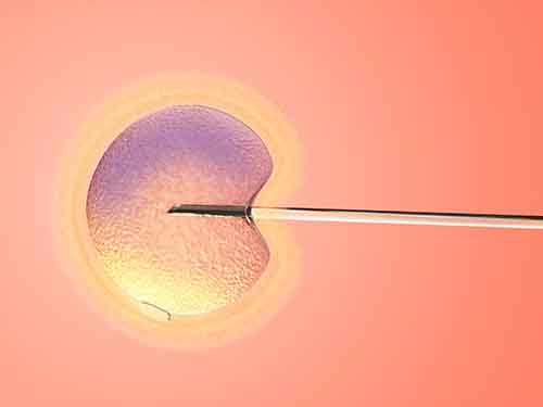 卵胞浆内单精子注射
