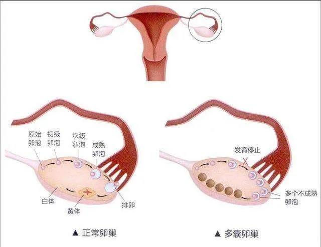 什么是多囊卵巢综合征(PCOS)?