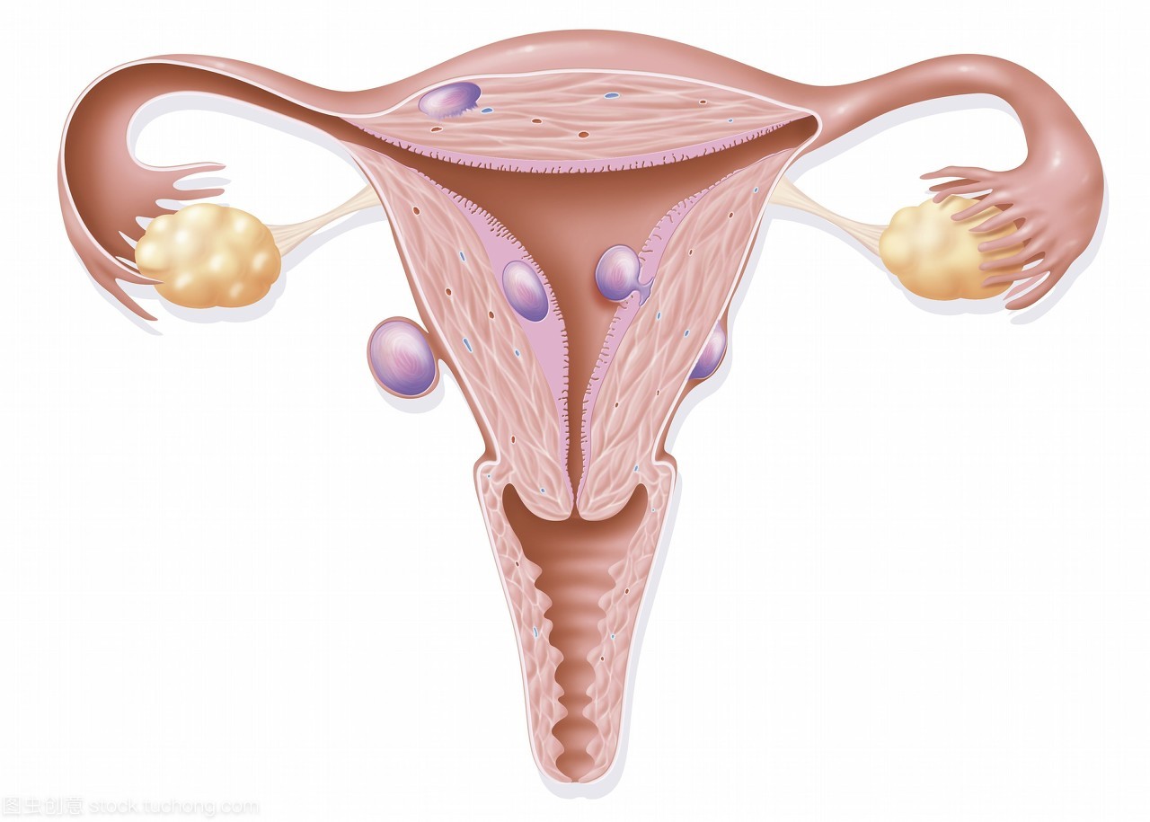 子宫肌瘤的治疗不能简单的“一刀切”