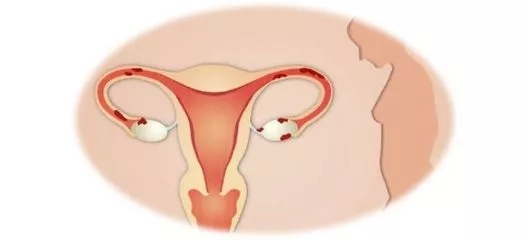 如何评估输卵管的通畅情况?