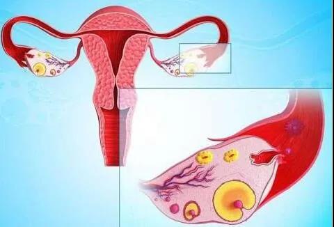 得了多囊卵巢综合征有什么表现？