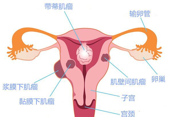 子宫肌瘤术后半年意外怀孕，孩子可以保留吗？