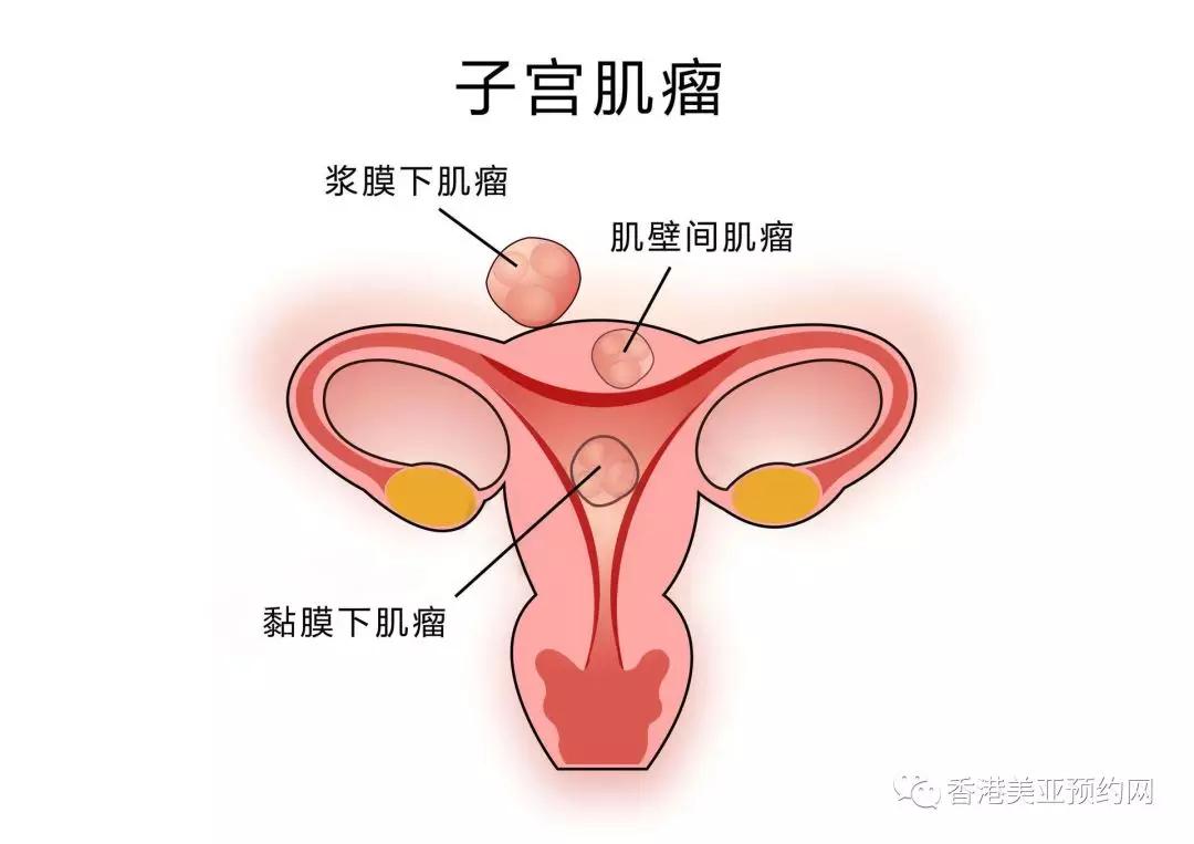 子宫肌瘤手术后多久可以怀孕