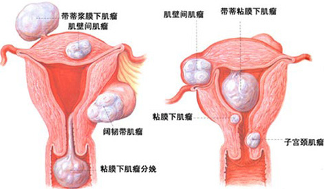 患了子宫肌瘤，先怀孕还是先手术？

