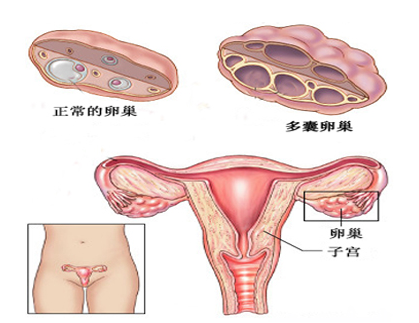 多囊症状那么多，该如何诊断？