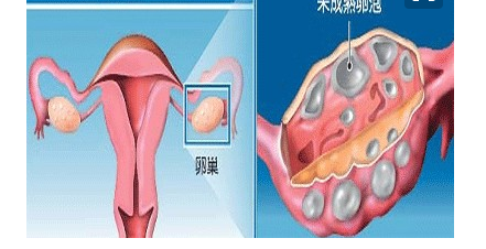 多囊卵巢综合征可以自愈吗