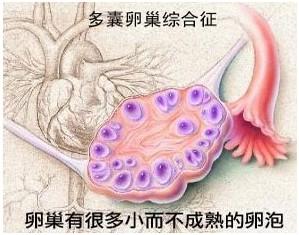 如何判断是否多囊卵巢综合征