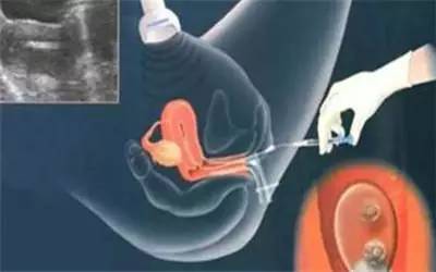 胚胎移植时为什么要憋尿？