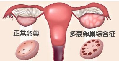 我多囊卵巢综合征了怎么办？