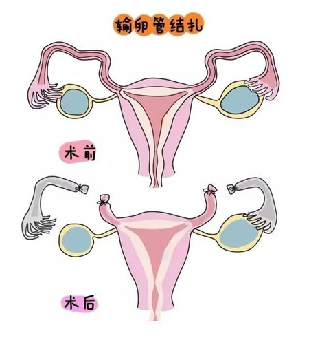 输卵管结扎