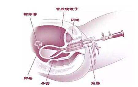 宫腔镜检查.jpg