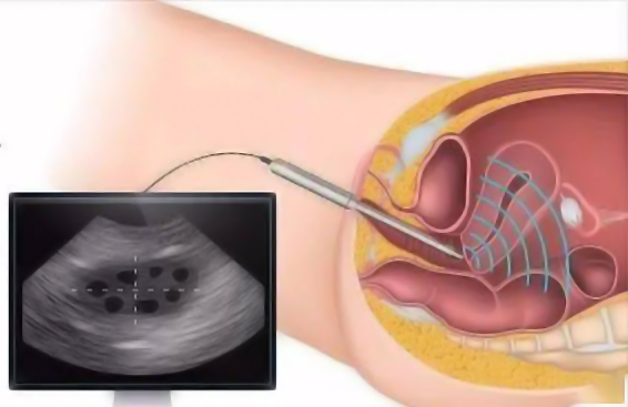 阴道超声检查