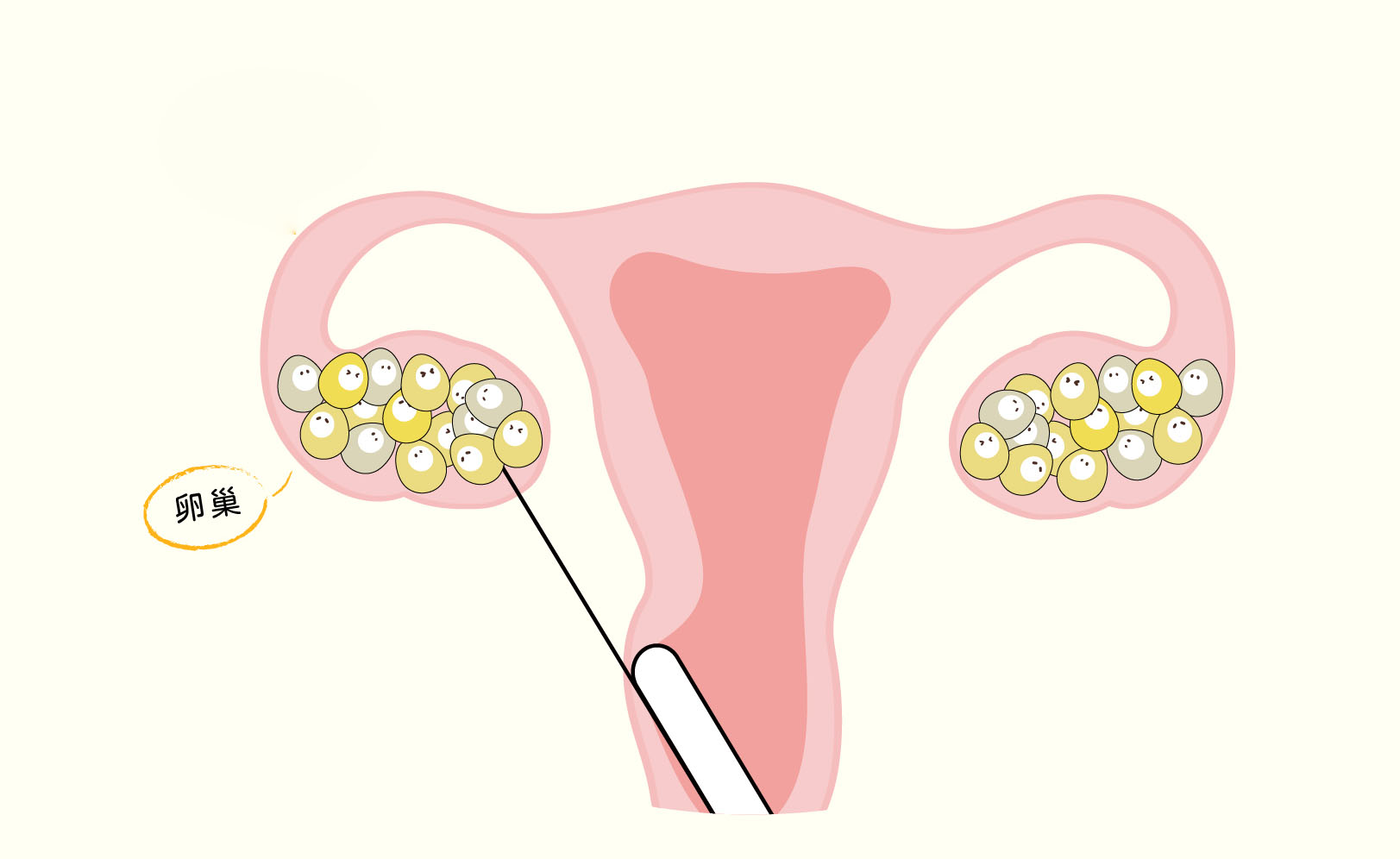 取卵过程卡通示意图